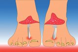 Sănătate cu alimente - Ciuperca piciorului